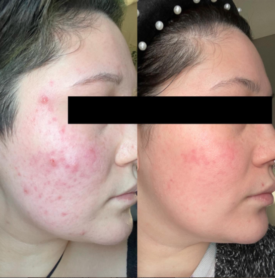 A before and after photo of one of Sofie's clients taken from her instagram. In the before the client's face has acne and is red/inflammed looking. After the client's skin looks calm and clear.
