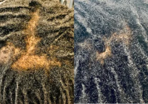 A before and after photo from Bridgette's website, of someone with scalp hair loss