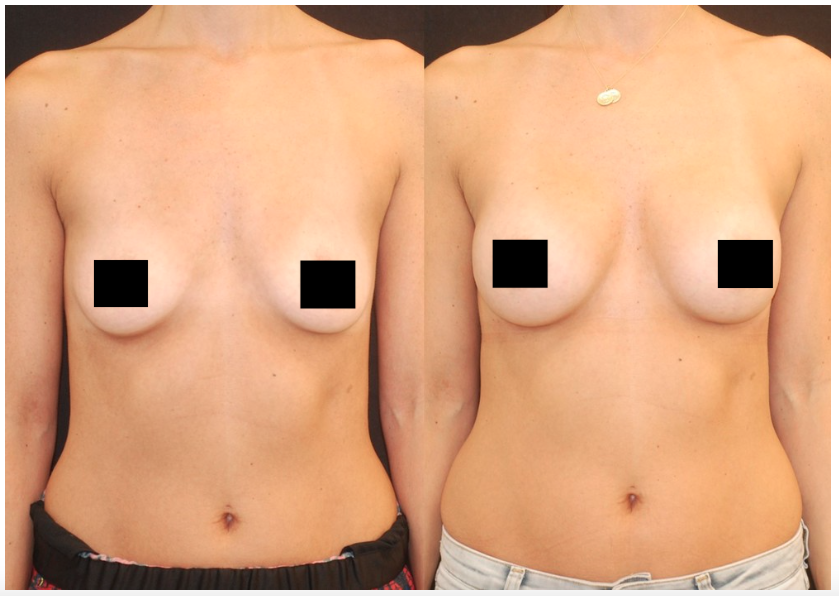 A before and after photo courtesy of Dr. Lara Devgan's website of a client who got breast implants
