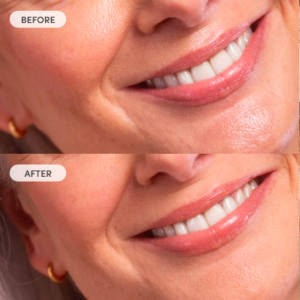A Before and After from Trinny London that shows how affective the Miracle Blur is. The after photo shows a woman's mouth area with smoother skin and less wrinkles appearing